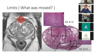 HIFU Efficacy in Low and Intermediate Risk PCa ( Thesis Viva)