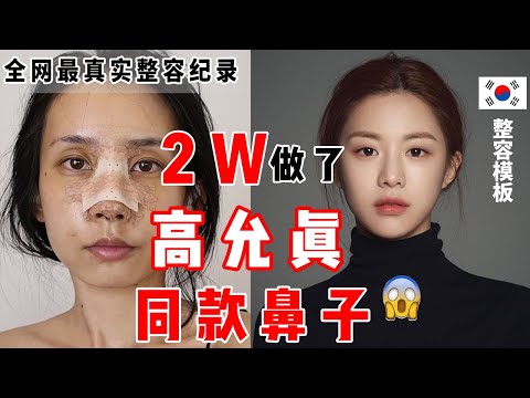 只花了2W就做了高允真同款美鼻？！术后痛到想去世的整容全过程记录