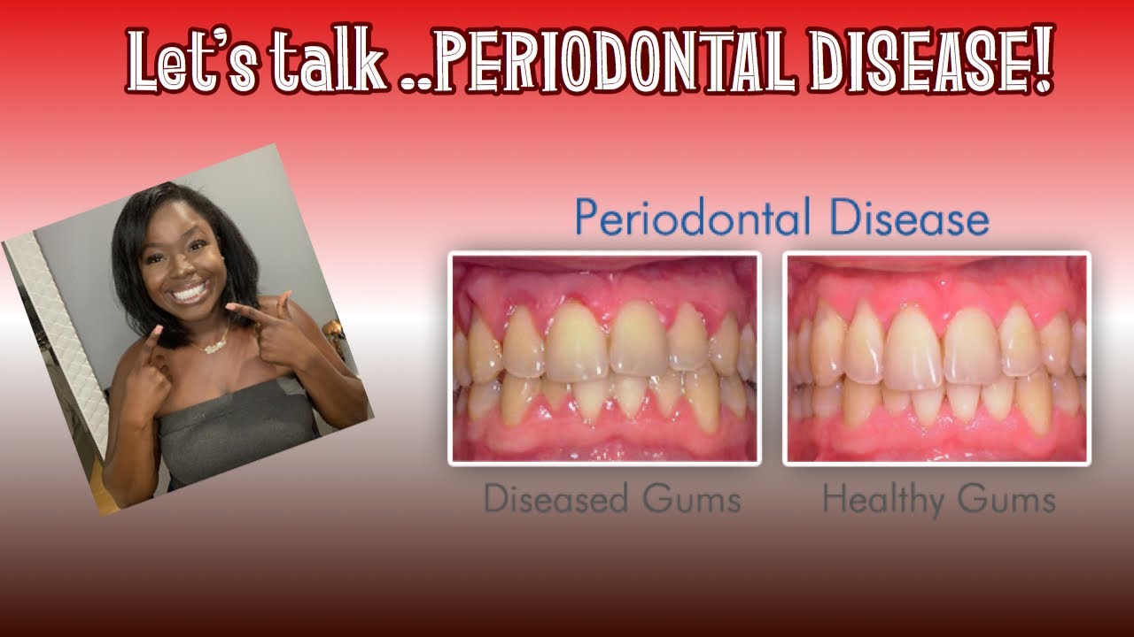Periodontal Disease Deep Cleanings YouTube