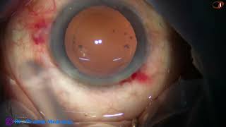 Prechopping is the way to go in Soft Cataracts - slow motion at the end of this video : P Mohanta