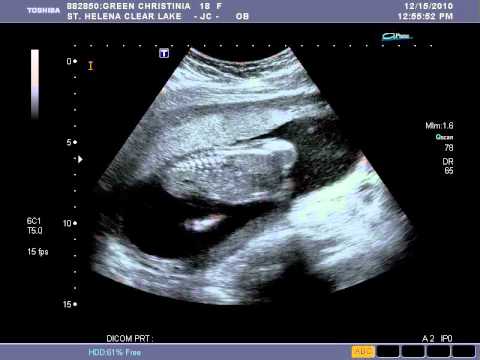 Kassie Vaughn's Ultrasound Video (5)