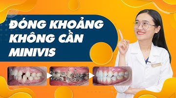 Niềng Răng Đóng Khoảng Không Cần Minivis | Case Lâm Sàng Niềng Răng |Nam Bùi Vinalign