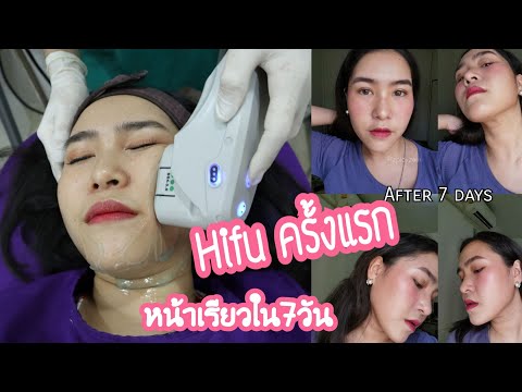 Review : ทำ Hifu ครั้งแรก หน้าเข้ารูปใน7วัน / ตอบหมดทุกคำถาม  | PZployzaiiii