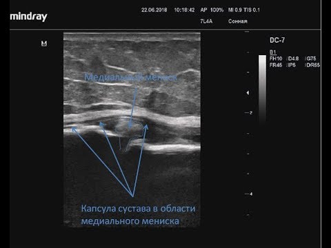 узи анатомия коленного сустава. гемартроз коленного сустава узи. узи признаки разрывов связок коленного сустава. собственная связка надколенника узи. синовиальная оболочка коленного сустава на узи.