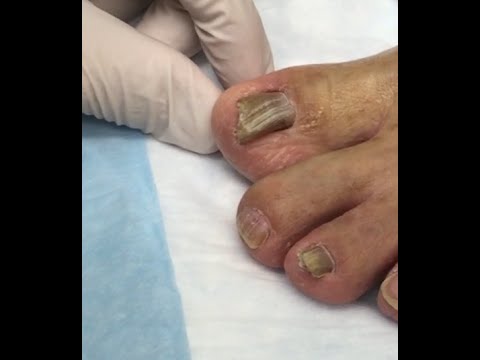 Jorge Came Back!  Toenail Fungus Treatment With Gumby & Gonzo