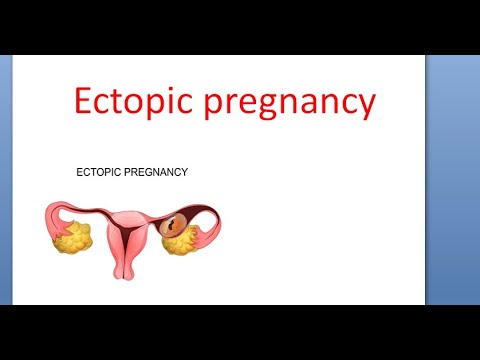 Obstetrics 237 Ectopic Pregnancy Define Site Cause Fate Treatment Surgery