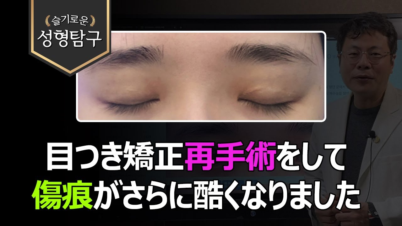 【韓国二重整形相談】目つき矯正再手術の傷痕が気になります