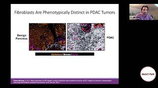 Small Netrin (G1): stroma-Derived Extracellular Vesicles in Pancreatic Cancer by Kris Raghavan