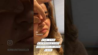 Folgen Von Kristallkortison In Der Nase