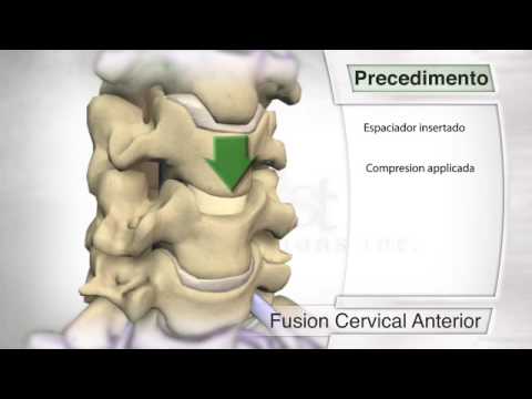 Fusión Intersomática - vista anterior vertebral level of liver