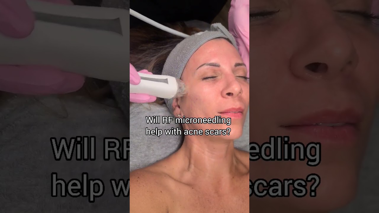Rf microneedling and acne scars