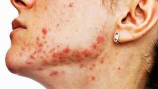 Chemický Peeling Redpeel Od Laboratoires Renophase