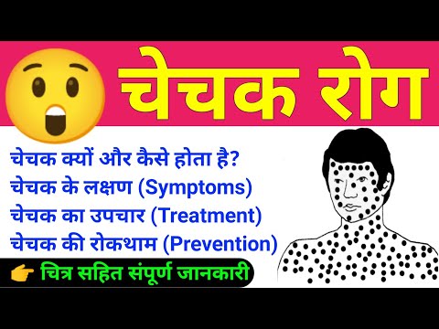 वीडियो: चेचक कैसे फैलता है?