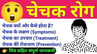 चेचक रोग | chechak rog | chechak ke lakshan | chechak ka tika | Chicken pox | Small pox | biology