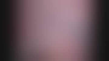 Asvide: Subxiphoid robotic thymectomy procedure