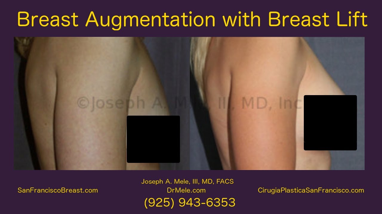 Breast Augmentation with Breast Lift (Augmentation Mastopexy) Bay Area - 4 of 4