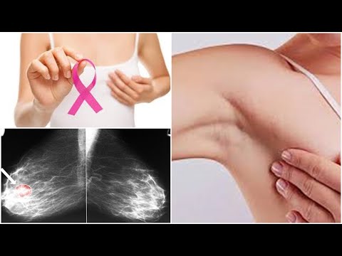 Βίντεο: Περισσότερες γυναίκες πεθαίνουν από αυτόν τον καρκίνο από ό, τι πιστεύαμε