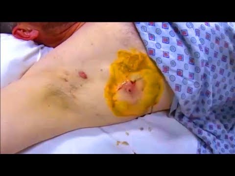 Armpit Abscess Drainage Proceure in Emergency Room