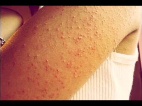 How to Get Rid of Bumps on Arms