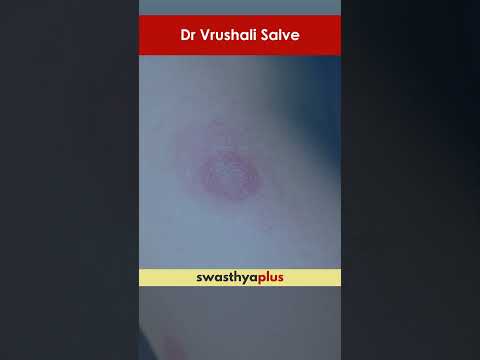 बुरशीचा संसर्गची लक्षणे काय आहेत? | Symptoms of Fungal Infection | Dr Vrushali Salve | #Shorts