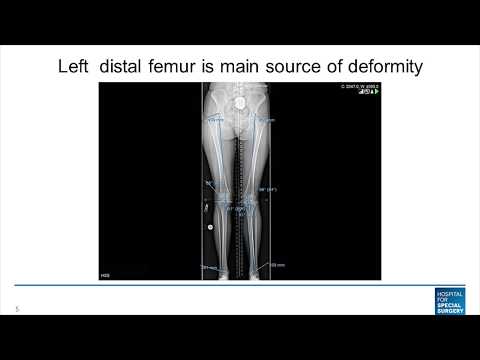 Distal Femur Osteotomy to Correct Valgus Knock Knee Deformity - Distal Femur Osteotomy to Correct Valgus Knock Knee Deformity