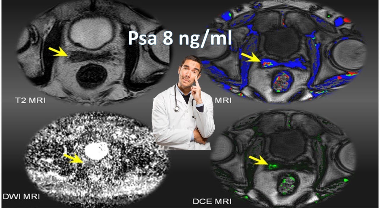 risonanza magnetica multiparametrica prostata pisa 2