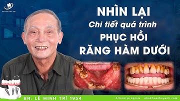 Reaction #13: Nhìn lại quá trình 3 tháng trồng toàn bộ răng hàm dưới