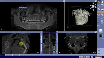 CBCT Saggital Image Plane