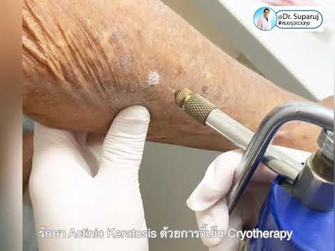 ผื่นแอกทินิกเคอราโทซิส Actinic keratosis, AK