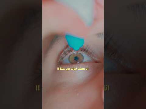 تجربتي مع الليزك بعد سنة