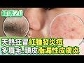 天熱狂冒紅腫發炎痘 多眉毛、頭皮脂漏性皮膚炎【健康2.0分段】@tvbshealth20  EP3204-3 20260613 #鄭凱云#羅佳琳#蔡逸姍#余雅雯#彥寬