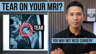 Hip Labral Tear: Surgery or Not | HealthFit Pasadena