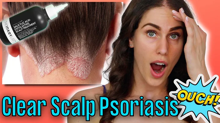 Why My Hair Is Falling Out & Scalp Is Bleeding - P...