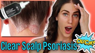 Why My Hair Is Falling Out & Scalp Is Bleeding - Psoriasis & Scalp Conditions W/ Derm Candrice Heath
