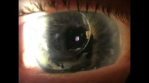 Dislocated IOL Case #1: Post-Trauma