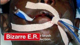 How Surgeons Removed An Impaled Toothbrush From A Boy - Bizarre ER