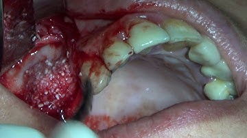 GBR WITH TENTING SCREWS