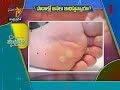 Foot Corns and Treatments | Health Tip | Sukhibhava | 2nd February 2021 | ETV AP