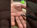 Natural treatment with nature #trigger finger# tennis elbow#finger pain relief#