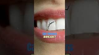 Cosmetic dentist answers: can veneers break? Profile