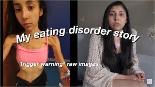 MY EATING DISORDER STORY. (anorexia, bulimia, orthorexia). Raw,  with pictures & HOW I RECOVERED