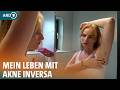 Akne Inversa: So wird die Hauterkrankung behandelt I ARD Gesund