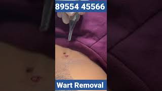 Wart Removal On Neck || Dr deepesh Goyal - Rejuvena Cosmo Care |