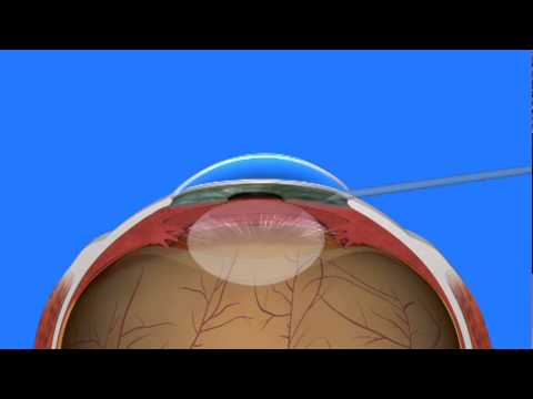 Cataract Surgery