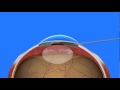 Cataract surgery