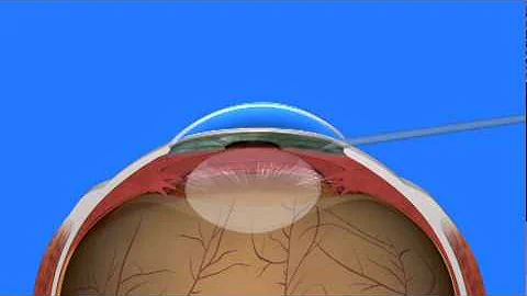 Cataract Surgery - DayDayNews