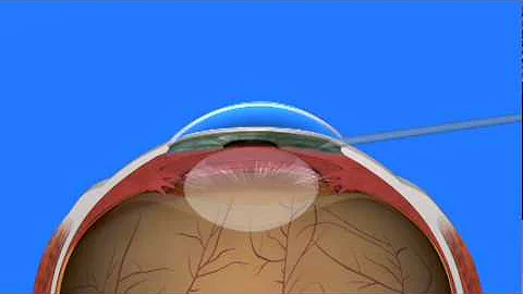 Cataract Surgery