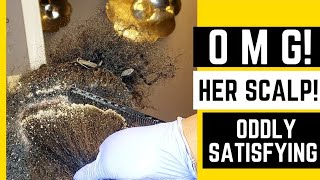 Oddly Satisfying Extreme Flakes Scalp Condition Must See Removal from Hair &amp; Scalp After Style Pt 1