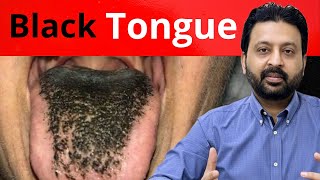 Why Your Tongue Looks Black and Hairy — And What to Do About It at Home