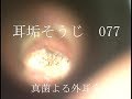 耳垢そうじ/耳が痛くて痒い外耳炎の動画/077